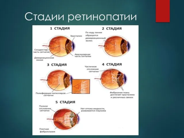 Стадии ретинопатии