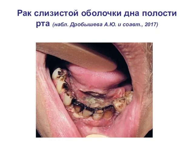 Рак слизистой оболочки дна полости рта (набл. Дробышева А.Ю. и соавт., 2017)