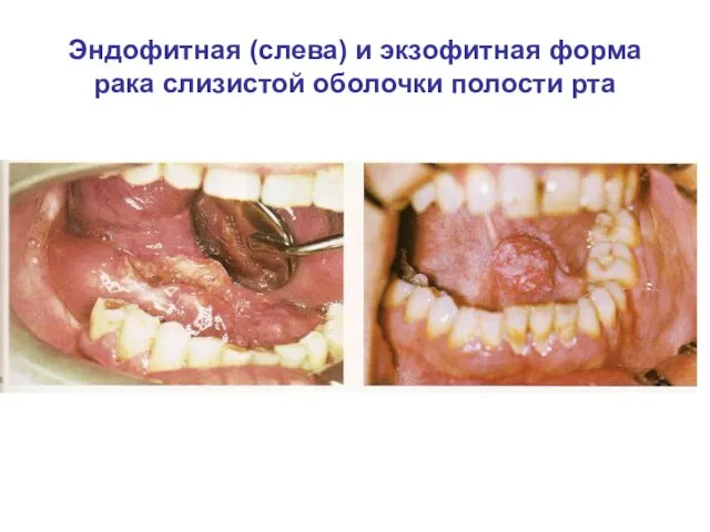 Эндофитная (слева) и экзофитная форма рака слизистой оболочки полости рта