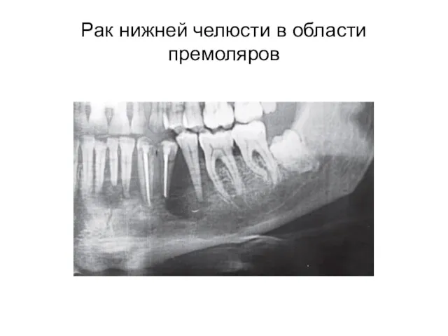 Рак нижней челюсти в области премоляров