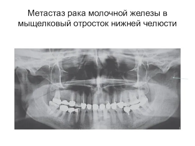 Метастаз рака молочной железы в мыщелковый отросток нижней челюсти