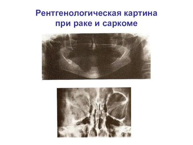 Рентгенологическая картина при раке и саркоме