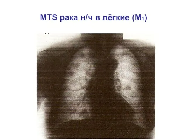 MTS рака н/ч в лёгкие (M1)