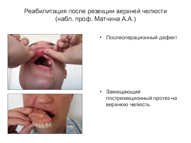 Реабилитация после резекции верхней челюсти (набл. проф. Матчина А.А.) Послеоперационный дефект Замещающий