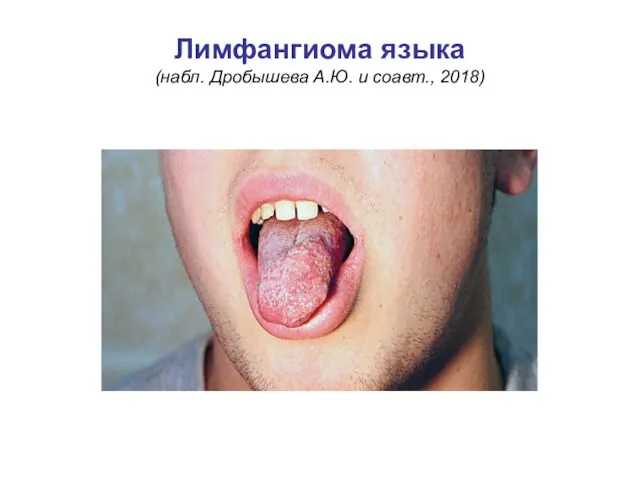 Лимфангиома языка (набл. Дробышева А.Ю. и соавт., 2018)