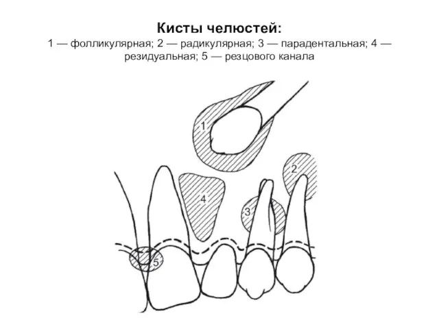 Кисты челюстей: 1 — фолликулярная; 2 — радикулярная; 3 — парадентальная; 4