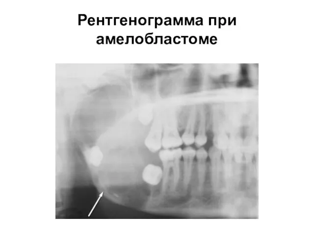 Рентгенограмма при амелобластоме