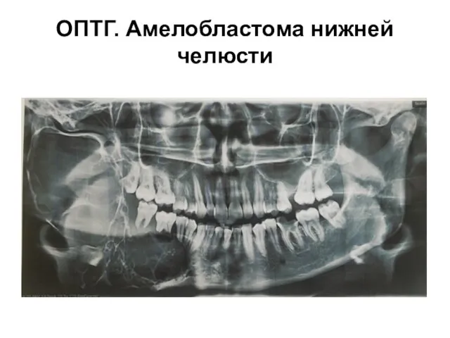 ОПТГ. Амелобластома нижней челюсти