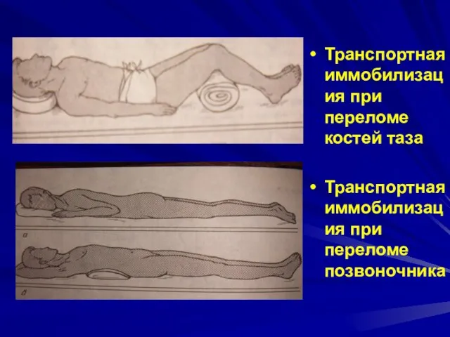 Транспортная иммобилизация при переломе костей таза Транспортная иммобилизация при переломе позвоночника