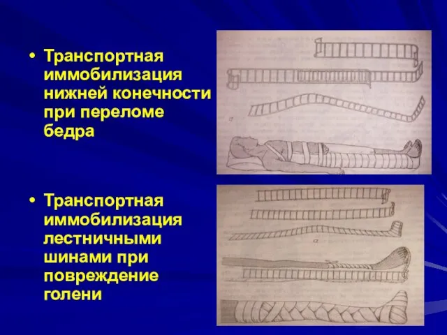 Транспортная иммобилизация нижней конечности при переломе бедра Транспортная иммобилизация лестничными шинами при повреждение голени