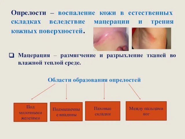 Опрелости – воспаление кожи в естественных складках вследствие мацерации и трения кожных