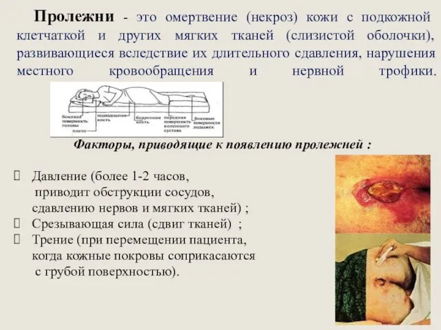 Пролежни - это омертвение (некроз) кожи с подкожной клетчаткой и других мягких