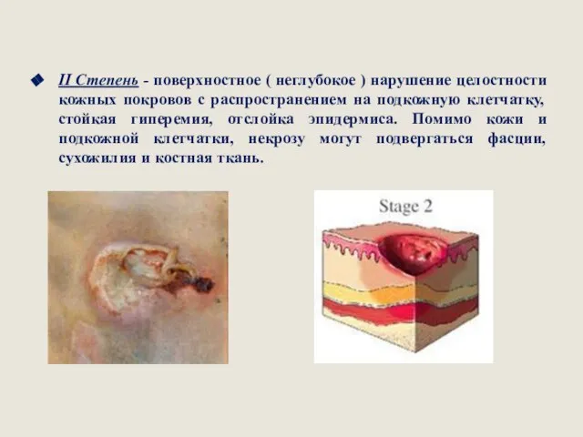 II Степень - поверхностное ( неглубокое ) нарушение целостности кожных покровов с