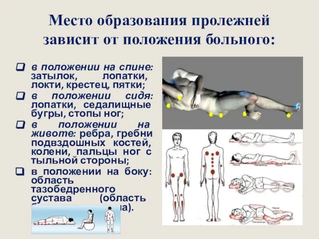 Место образования пролежней зависит от положения больного: в положении на спине: затылок,