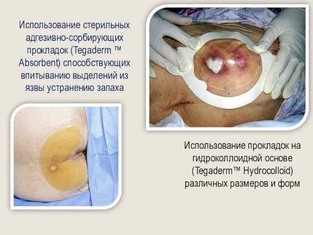 Использование прокладок на гидроколлоидной основе (Tegaderm™ Hydrocolloid) различных размеров и форм Использование