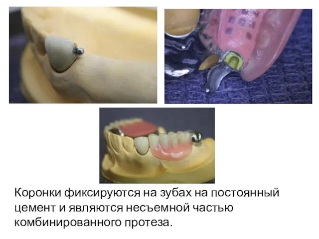 Коронки фиксируются на зубах на постоянный цемент и являются несъемной частью комбинированного протеза.