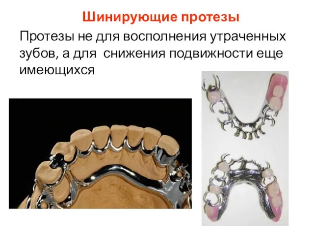 Шинирующие протезы Протезы не для восполнения утраченных зубов, а для снижения подвижности еще имеющихся