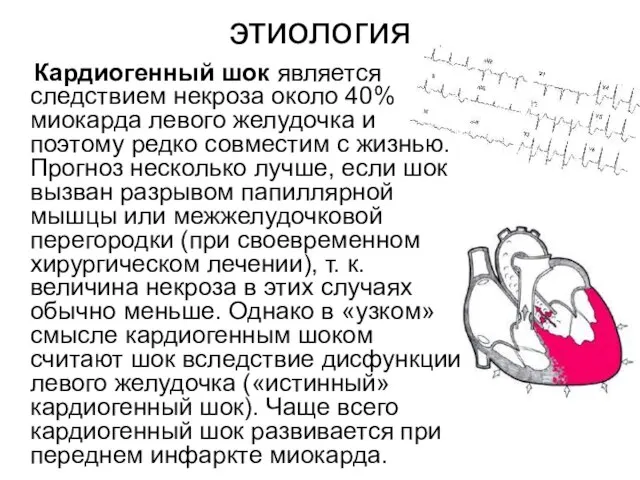 этиология Кардиогенный шок является следствием некроза около 40% миокарда левого желудочка и