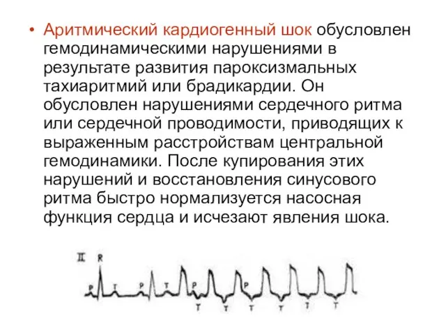 Аритмический кардиогенный шок обусловлен гемодинамическими нарушениями в результате развития пароксизмальных тахиаритмий или