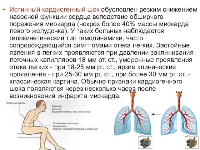 Истинный кардиогенный шок обусловлен резким снижением насосной функции сердца вследствие обширного поражения