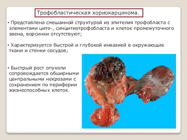 Трофобластическая хориокарцинома. Представлена смешанной структурой из эпителия трофобласта с элементами цито-, синцитиотрофобласта