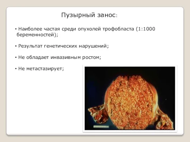 Пузырный занос: Наиболее частая среди опухолей трофобласта (1:1000 беременностей); Результат генетических нарушений;