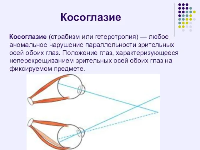 Косоглазие Косоглазие (страбизм или гетеротропия) — любое аномальное нарушение параллельности зрительных осей