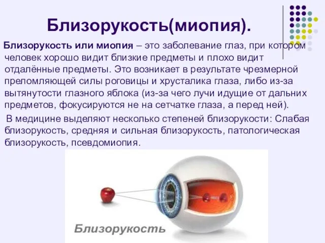 Близорукость(миопия). Близорукость или миопия – это заболевание глаз, при котором человек хорошо