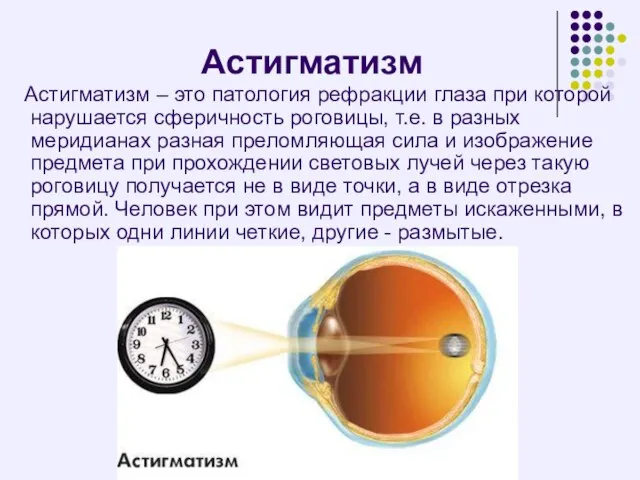 Астигматизм Астигматизм – это патология рефракции глаза при которой нарушается сферичность роговицы,