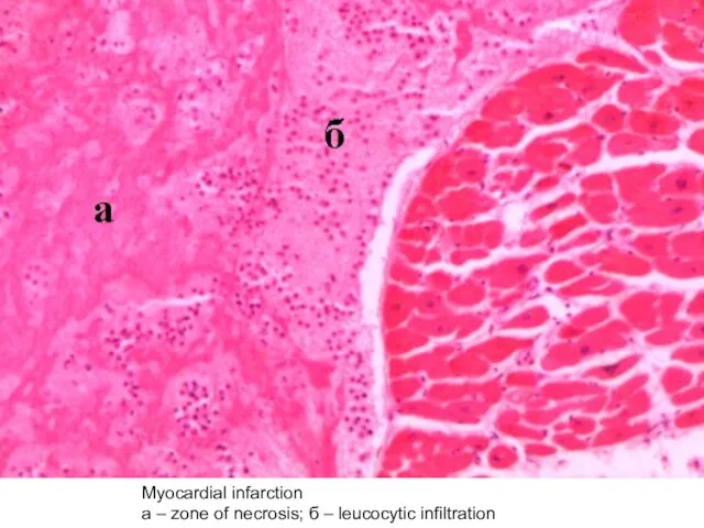Myocardial infarction а – zone of necrosis; б – leucocytic infiltration