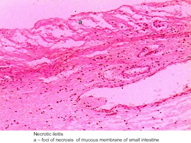 Necrotic ileitis а – foci of necrosis of mucous membrane of small intestine