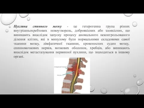 Пухлина спинного мозку - це гетерогенна група різних внутрішньохребтових новоутворень, доброякісних або