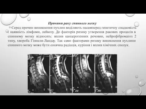 Причини раку спинного мозку Серед причин виникнення пухлин виділяють насамперед генетичну спадковість