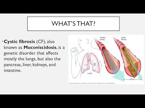 WHAT’S THAT? Cystic fibrosis (CF), also known as Mucoviscidosis, is a genetic