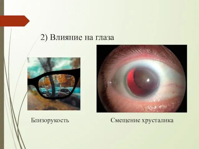 2) Влияние на глаза Близорукость Смещение хрусталика