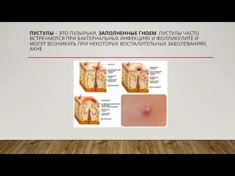 ПУСТУЛЫ – ЭТО ПУЗЫРЬКИ, ЗАПОЛНЕННЫЕ ГНОЕМ. ПУСТУЛЫ ЧАСТО ВСТРЕЧАЮТСЯ ПРИ БАКТЕРИАЛЬНЫХ ИНФЕКЦИЯХ