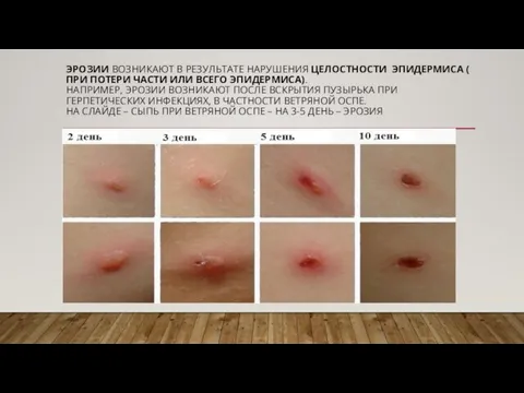 ЭРОЗИИ ВОЗНИКАЮТ В РЕЗУЛЬТАТЕ НАРУШЕНИЯ ЦЕЛОСТНОСТИ ЭПИДЕРМИСА ( ПРИ ПОТЕРИ ЧАСТИ ИЛИ