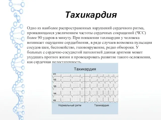 Тахикардия Одно из наиболее распространенных нарушений сердечного ритма, проявляющееся увеличением частоты сердечных