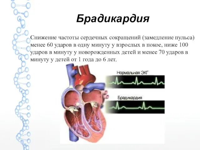 Брадикардия Снижение частоты сердечных сокращений (замедление пульса) менее 60 ударов в одну