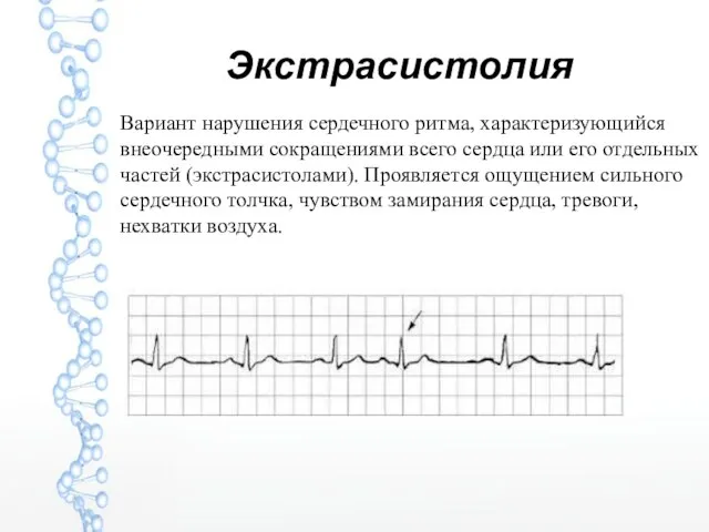 Экстрасистолия Вариант нарушения сердечного ритма, характеризующийся внеочередными сокращениями всего сердца или его