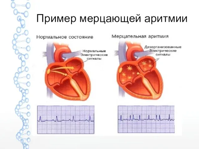 Пример мерцающей аритмии
