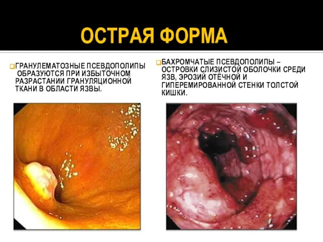 ОСТРАЯ ФОРМА ГРАНУЛЕМАТОЗНЫЕ ПСЕВДОПОЛИПЫ ОБРАЗУЮТСЯ ПРИ ИЗБЫТОЧНОМ РАЗРАСТАНИИ ГРАНУЛЯЦИОННОЙ ТКАНИ В ОБЛАСТИ