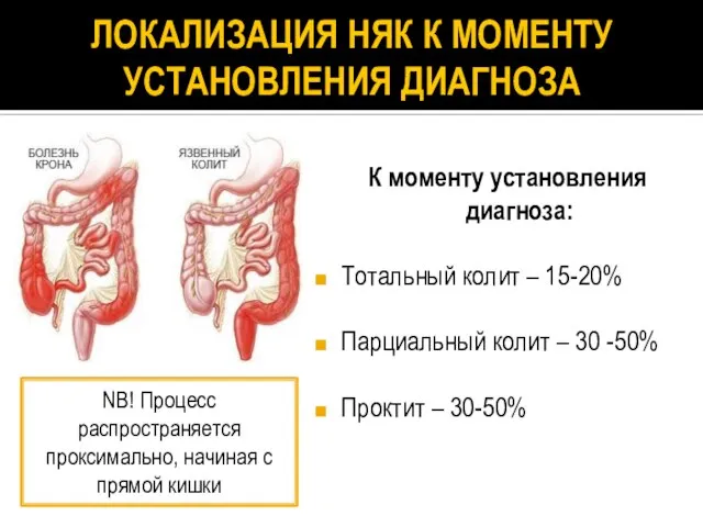 ЛОКАЛИЗАЦИЯ НЯК К МОМЕНТУ УСТАНОВЛЕНИЯ ДИАГНОЗА К моменту установления диагноза: Тотальный колит