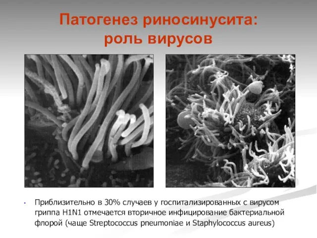 Патогенез риносинусита: роль вирусов Приблизительно в 30% случаев у госпитализированных с вирусом