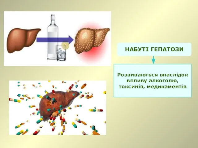 НАБУТІ ГЕПАТОЗИ Розвиваються внаслідок впливу алкоголю, токсинів, медикаментів