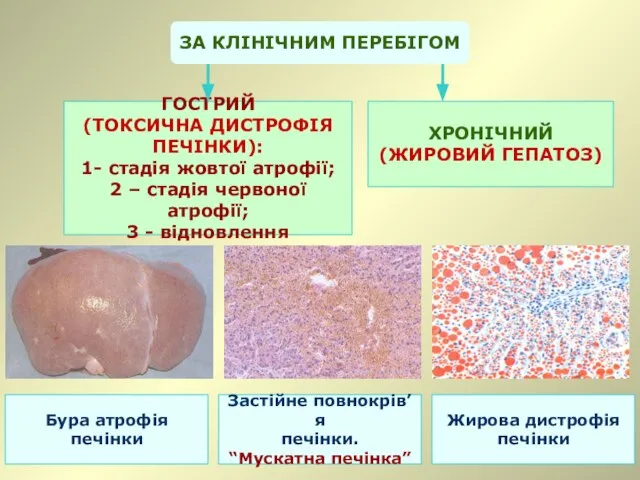 ГОСТРИЙ (ТОКСИЧНА ДИСТРОФІЯ ПЕЧІНКИ): 1- стадія жовтої атрофії; 2 – стадія червоної