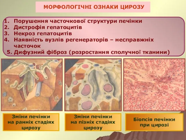 МОРФОЛОГІЧНІ ОЗНАКИ ЦИРОЗУ Порушення часточкової структури печінки Дистрофія гепатоцитів Некроз гепатоцитів Наявність