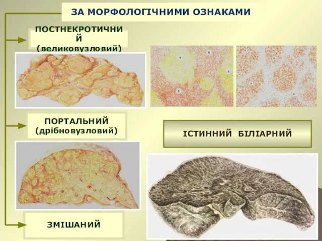 ЗА МОРФОЛОГІЧНИМИ ОЗНАКАМИ ПОСТНЕКРОТИЧНИЙ (великовузловий) ПОРТАЛЬНИЙ (дрібновузловий) ЗМІШАНИЙ ІСТИННИЙ БІЛІАРНИЙ