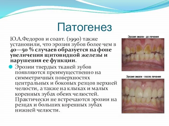 Патогенез Ю.А.Федоров и соавт. (1990) также установили, что эрозия зубов более чем