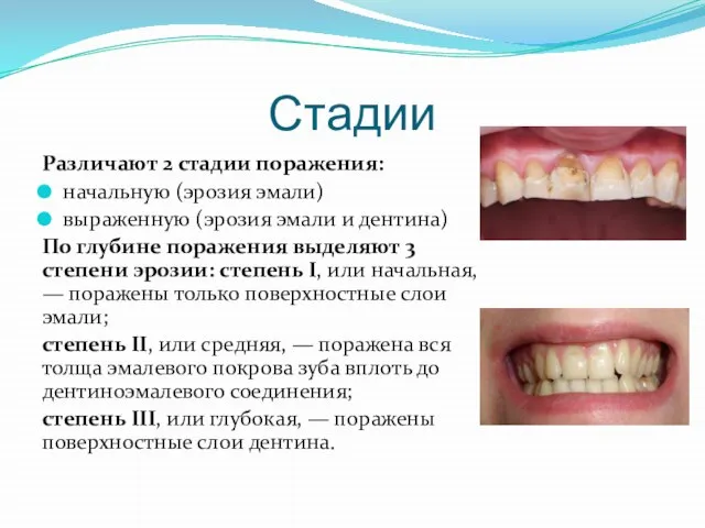 Стадии Различают 2 стадии поражения: начальную (эрозия эмали) выраженную (эрозия эмали и